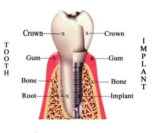 dental_implants_crown